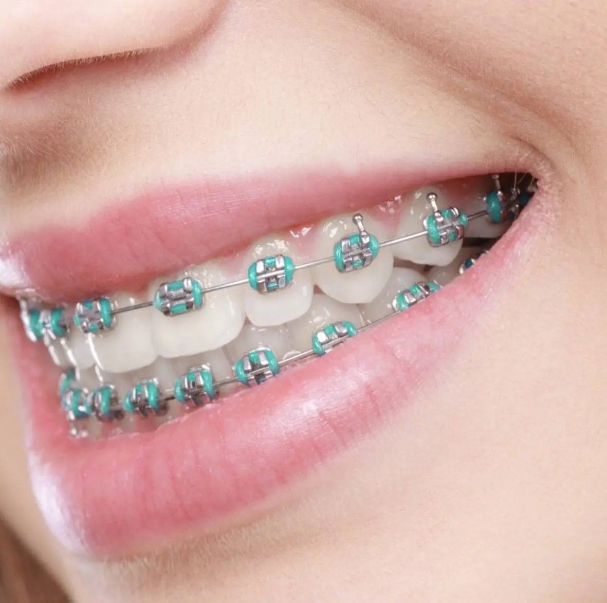 A close-up of a person smiling reveals teeth with metal braces and light blue rubber bands, showcasing the results achieved at Stellar Orthodontics in San Marcos, CA.