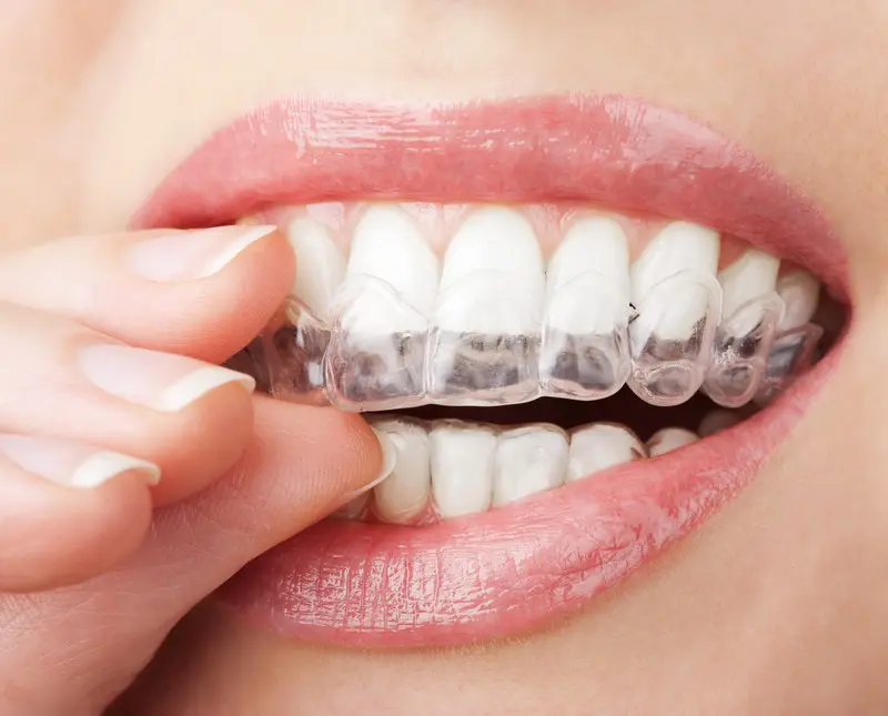 At Stellar Orthodontics in San Marcos CA, a clear aligner is being placed over upper teeth, demonstrating the discreet smile transformation possible with Invisalign.