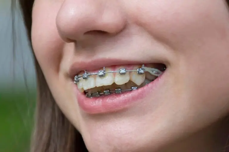 At Stellar Orthodontics, a close-up reveals braces for overbite in San Marcos, CA with an elastic band attached to the brackets on a person's teeth.