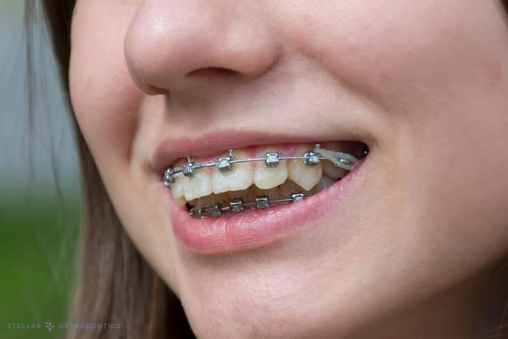 A person smiles, displaying metal braces with elastics, at Stellar Orthodontics in San Marcos, CA - Overbite vs Underbite in San Marcos, CA.