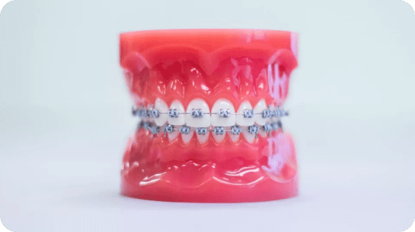 A dental model with metal braces is shown against a white background at Stellar Orthodontics in San Marcos, CA.